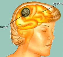 http://www.hipernatural.com/images/enfermedades/tumores_cerebrales.jpg