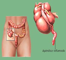Appendicite - HIPERnatural.COM