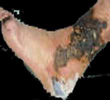 ARTERIOSCLEROSISOBLITERANTE - HIPERnatural.COM