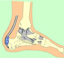 BURSITIS - HIPERnatural.COM