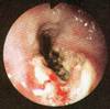 Cancerdel'sophage - HIPERnatural.COM