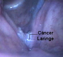 cancer_de_laringe.jpg