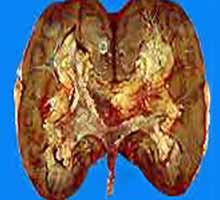Cancerdurein - HIPERnatural.COM