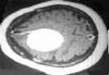 CNCERDELSISTEMANERVIOSOCENTRAL(CEREBROYMDULAESPINAL) - HIPERnatural.COM