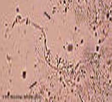 CANDIDIASIS - HIPERnatural.COM
