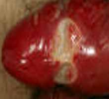 Chancroid - HIPERnatural.COM