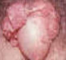 CONDILOMATOSIS - HIPERnatural.COM