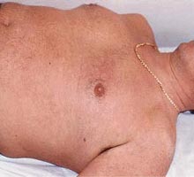 Denguehmorragique - HIPERnatural.COM
