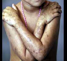 Atopicdermatitis - HIPERnatural.COM