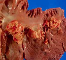 ENDOCARDITIS - HIPERnatural.COM