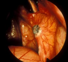 ENDOMETRIOSIS - HIPERnatural.COM