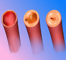 Maladieartriellepriphrique - HIPERnatural.COM