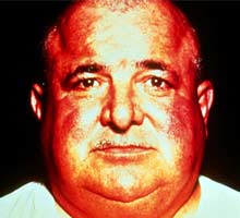 DISEASEOFCUSHING - HIPERnatural.COM