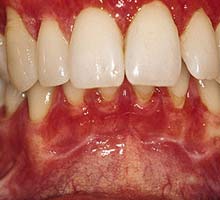 Les maladies parodontales - HIPERnatural.COM