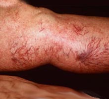 Phlebitis - HIPERnatural.COM