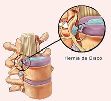Herniedudisque - HIPERnatural.COM