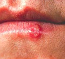HERPESlabial - HIPERnatural.COM