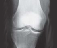Hypercalcemia - HIPERnatural.COM