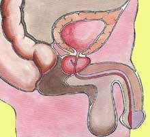HIPOGONADISMO - HIPERnatural.COM