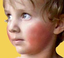 THEFIFTHDISEASE - HIPERnatural.COM