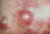 LINFOMA - HIPERnatural.COM