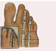 Neuroma�OF�MORTON - HIPERnatural.COM