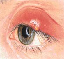 Stye - HIPERnatural.COM