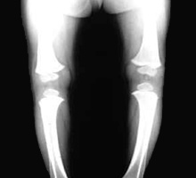 PIERNASARQUEADAS - HIPERnatural.COM