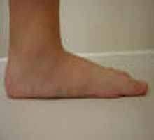 Congénitales problèmes de pieds - HIPERnatural.COM