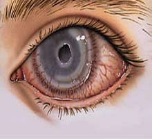 Keratitis - HIPERnatural.COM