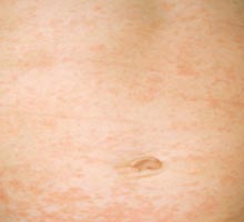 Roseola - HIPERnatural.COM