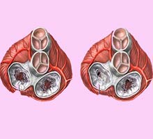 TRASTORNOSDELASVLVULASCARDACAS - HIPERnatural.COM