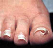 Incarnonglesdepieds - HIPERnatural.COM